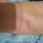 Эффективная мазь от экземы в Киеве и городах Украины