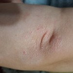 Эффективная мазь от дерматита в Киеве и городах Украины