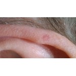 Эффективная мазь от псориаза на голове в Киеве и городах Украины