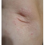 Де купити засіб від псоріазу на голові у Києві та містах України?