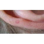 Де купити мазь від псоріазу на обличчі у Рівному та Рівненській області