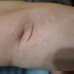 Де купити мазь від псоріазу на початковій стадії у Івано-Франківську та Івано-Франківскій області